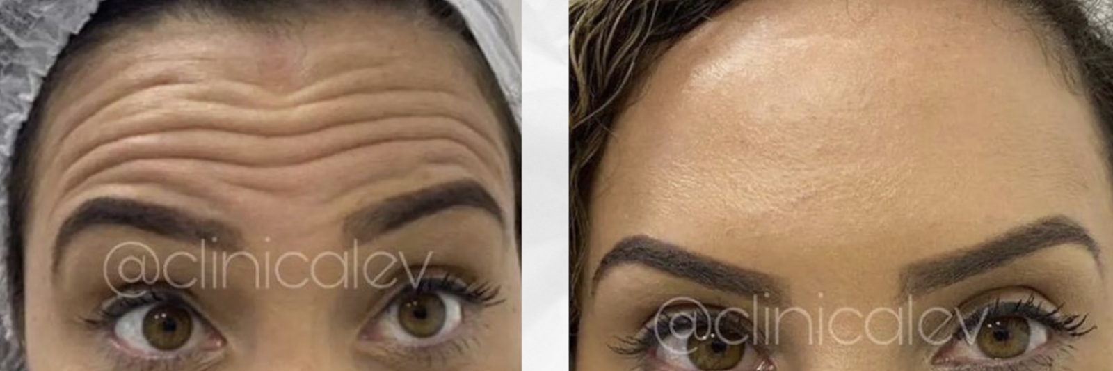 Antes e depois - Harmonização facial