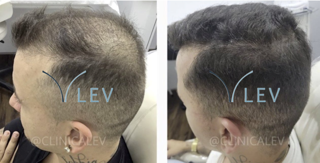 Antes e depois - Redução de rarefação capilar masculina