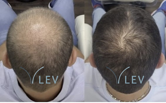 Antes e depois - Recué frontal e topo masculino